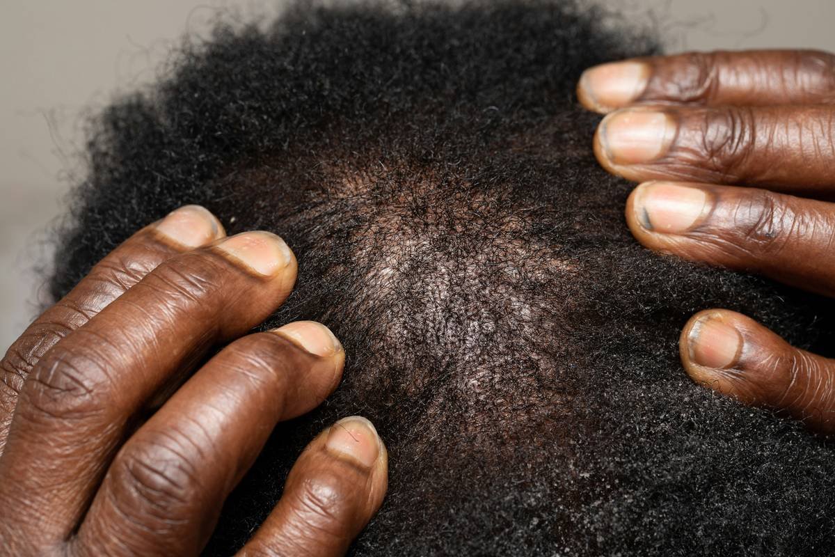 Diagram showing healthy vs inflamed scalp with hair follicles, sebum buildup, and microbial balance